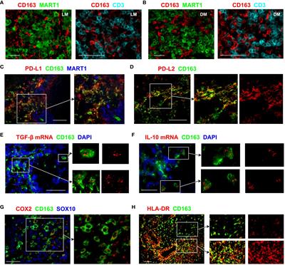 Proliferating macrophages in human tumours show characteristics of monocytes responding to myelopoietic growth factors